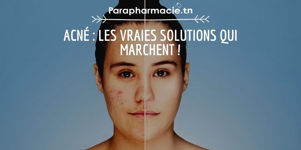 Acné : Les vraies solutions qui marchent ! | Parapharmacie.tn