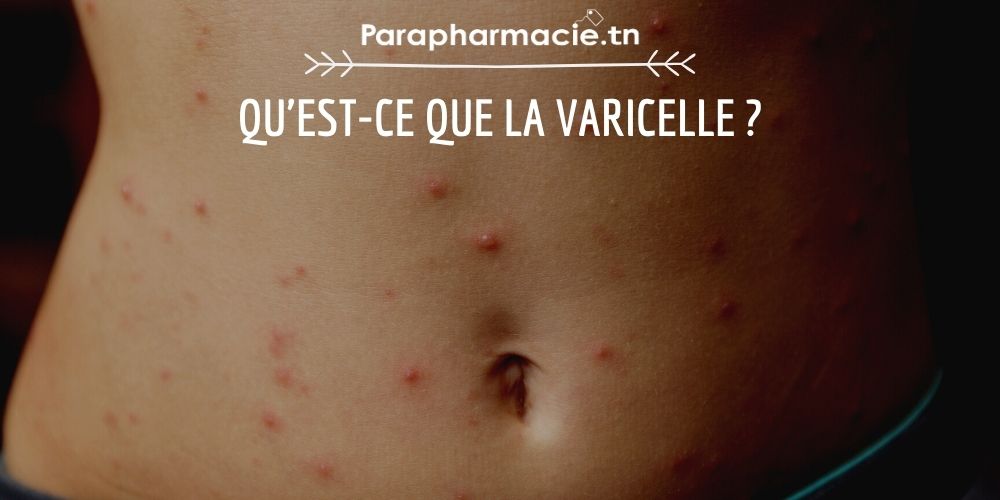 Qu'est-ce que la varicelle ? | Parapharmacie.tn